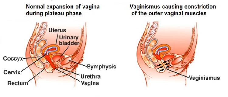 Tight vagina: Is my vagina too tight?