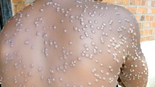 Namibia: Ouministili woundjolowele inau popya nande fiyo opapa ngee opu na ngaa ovenda yepulu loondjima – Oshiwambo Namibia: Ouministili woundjolowele inau popya nande fiyo opapa ngee opu na ngaa ovenda yepulu loondjima – Oshiwambo